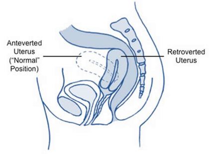 Retroverted uterus
