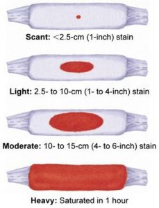 Implantation Bleeding Color Vs. Period (on Toilet Paper, Pad ...