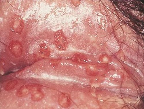 Vaginal blisters and sores from herpes pictures