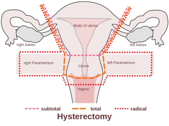 Sore ovaries after hysterectomy