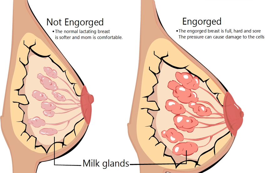 Engorged breasts