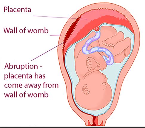 Placental abruption source Tommys