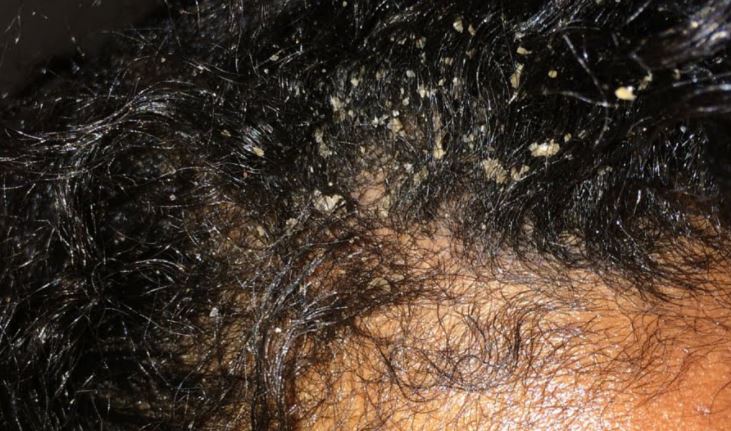Is it dandruff or a dry scalp