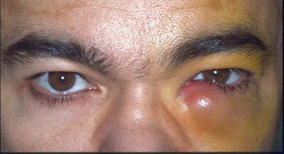 Inflamed or itchy tear duct swelling due to infection