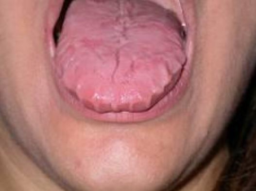 Scalloped tongue anxiety