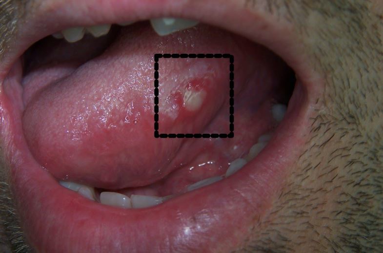 Bumps on sides of tongue pictures