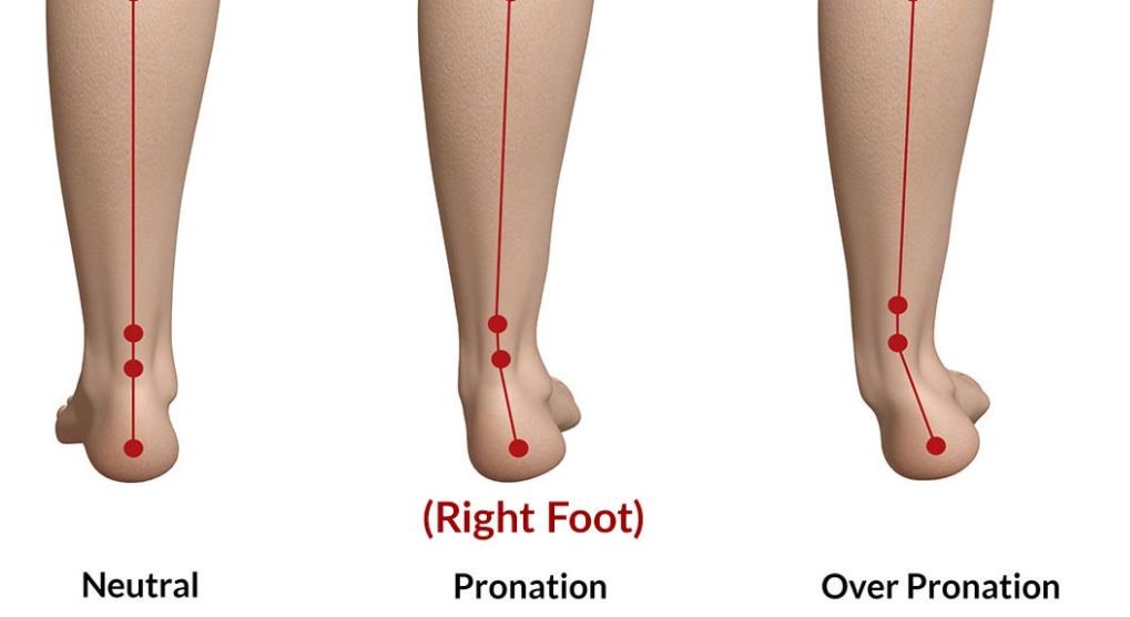 Foot pronation types