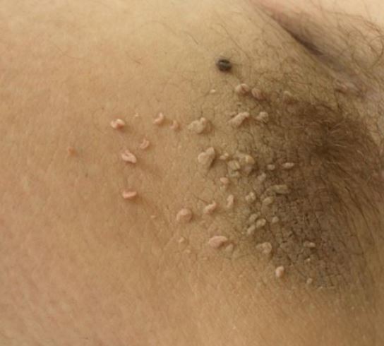Skin Tags On Penis Shaft 22