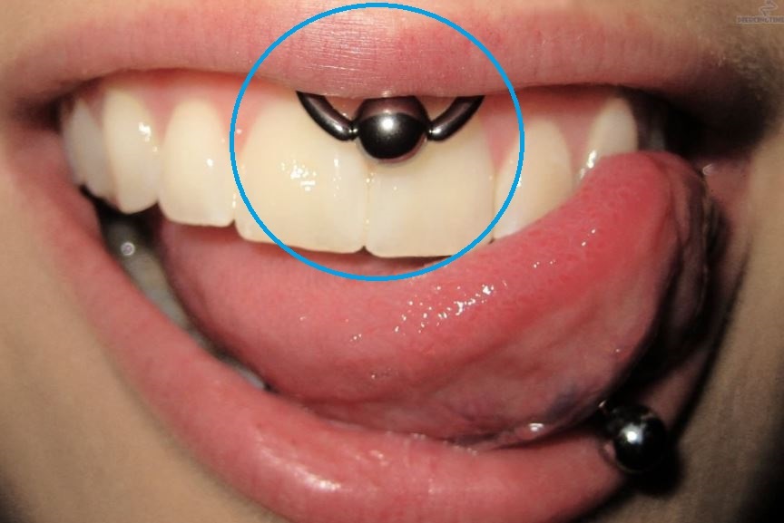 Gum piercing also called smiley piercing picture 1