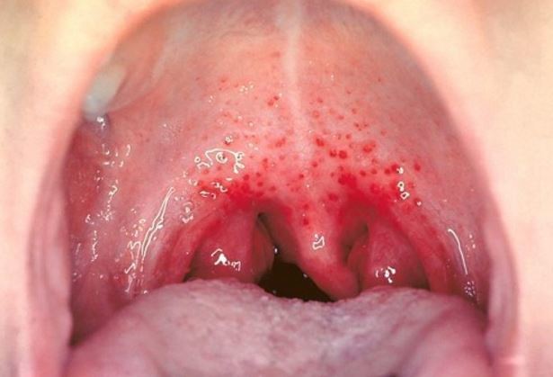 Red spots on roof of mouth picture