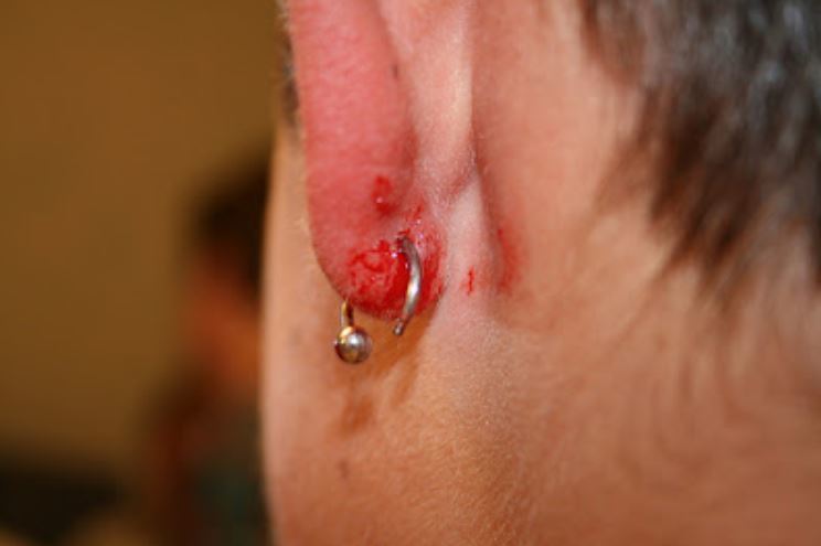 infected ear piercing signs